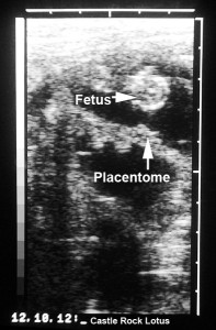 This image shows one of the fetuses, looking down from the top of the head, and a placental structure called a placentome
